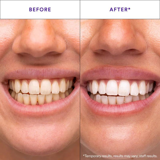 Teeth Whitening Strips